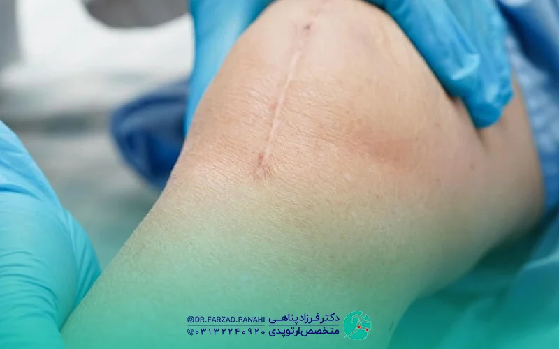انواع عمل تعویض مفصل زانو