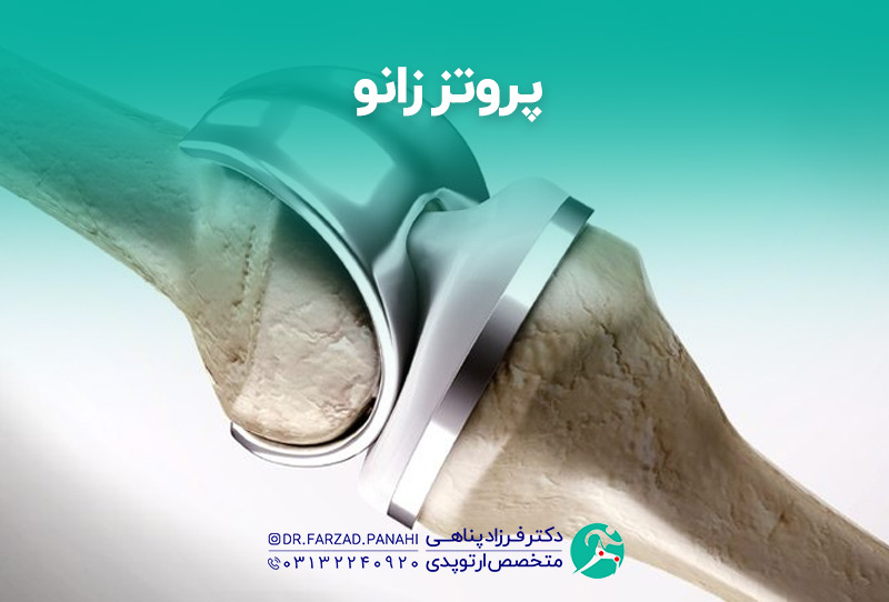 پروتز-زانو