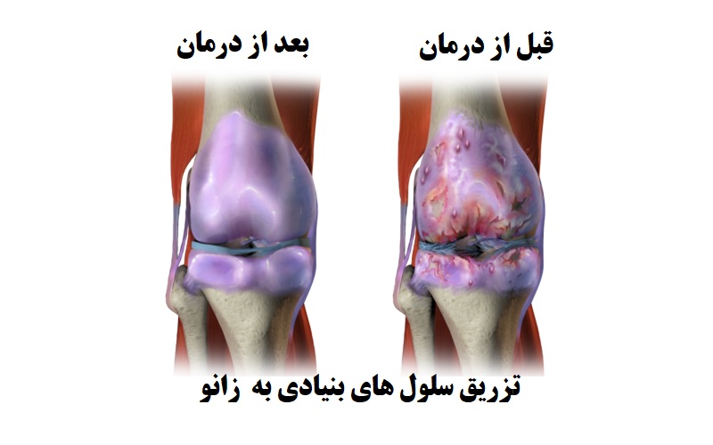 نظرات بیماران درباره درمان با عصاره جفت و سلول بنیادی 