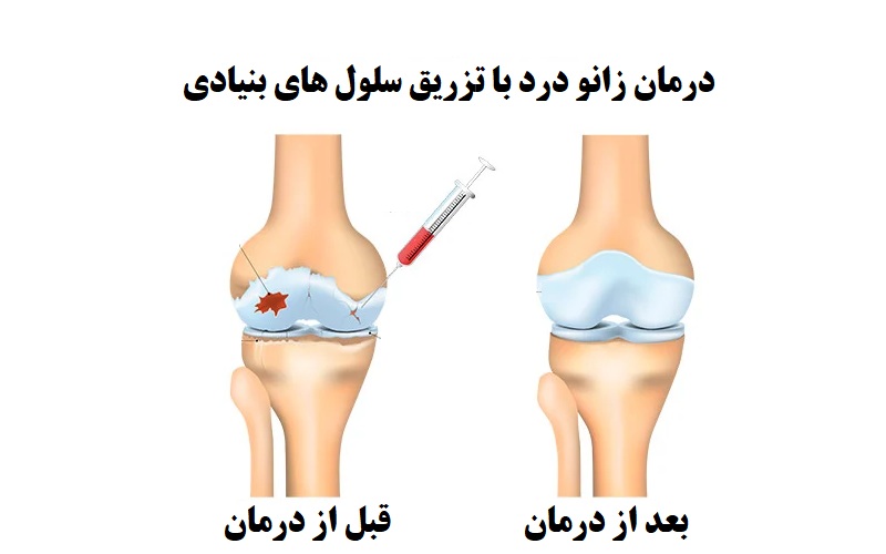 درمان زانو درد با سلول های بنیادی