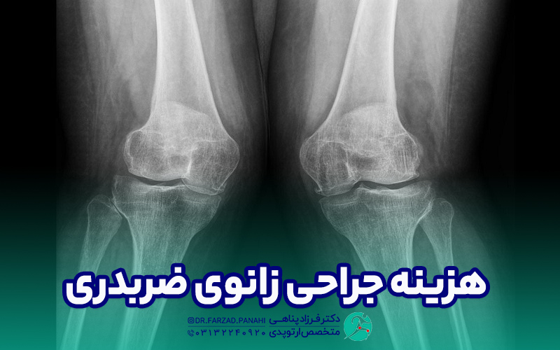 هزینه جراحی زانوی ضربدری، عوارض و مراقبت ها