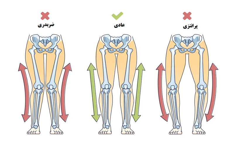 هزینه جراحی زانوی ضربدری چقدر است؟